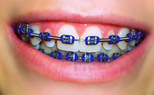 Chi phí niềng răng giá bao nhiêu tiền là hợp lý Chi phí niềng răng giá bao nhiêu tiền là hợp lý