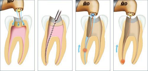 NKết hợp trồng implant để nâng đỡ cầu răng
