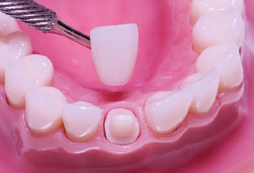 Độ bền của răng sứ là bao lâu?