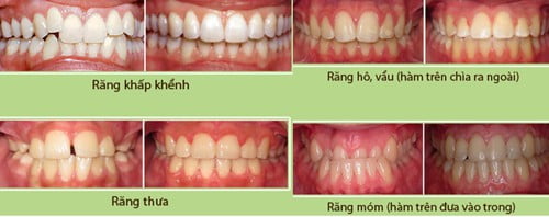 Niềng răng là giải pháp nha khoa tiên tiến