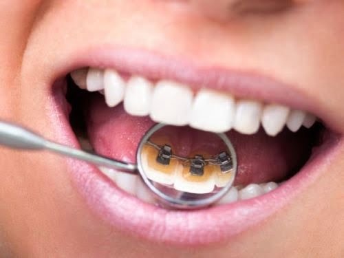Răng hô có cần niềng răng không?