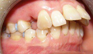 Phương pháp niềng răng hô
