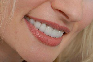 Bọc răng sứ cho răng hàm trên bị hô 2