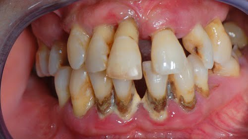 Điều trị bệnh răng miệng với răng sứ
