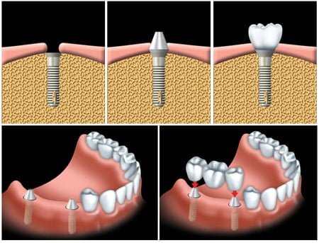 Làm răng implant bao nhiêu tiền?
