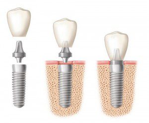 Làm răng implant bao nhiêu tiền?