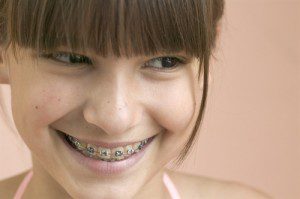 Những điều cần biết khi muốn niềng răng ở trẻ
