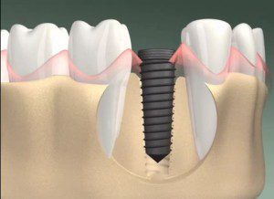 Lợi ích khi trồng răng giả implant cho răng hàm