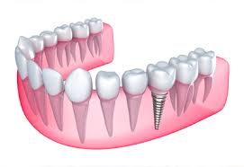 Lợi ích khi trồng răng giả implant cho răng hàm