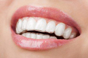 Răng hô có thể niềng răng trong suốt được không? 