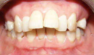Răng hô có thể niềng răng trong suốt được không? 
