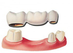 Trồng răng thay thế cho răng bị mất