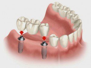 Trồng răng thay thế cho răng bị mất