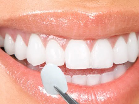  Bọc răng sứ có bền không ?