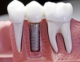 Khi nào làm răng giả cố định hoặc làm răng sứ