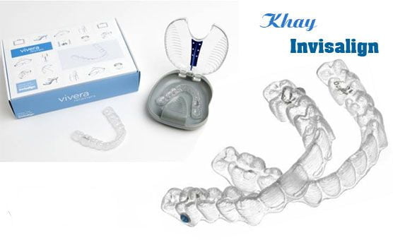 Niềng răng Invisalign có tốt không ? 1 Niềng răng Invisalign có tốt không ? 1