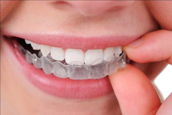 Niềng răng Invisalign có tốt không ? 2 Niềng răng Invisalign có tốt không ? 2