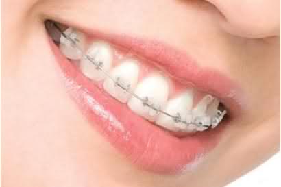 Niềng răng mắc cài sứ có hiệu quả không ?