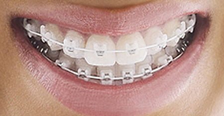 Niềng răng mắc cài sứ có hiệu quả không ?