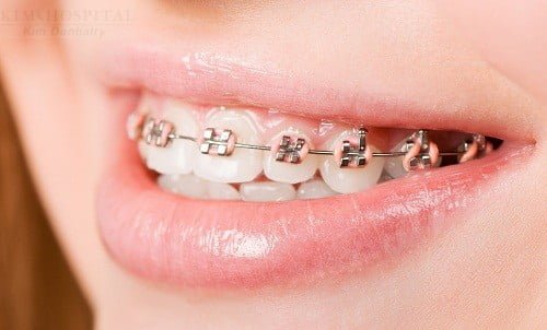 Phương pháp thẩm mỹ hàm răng
