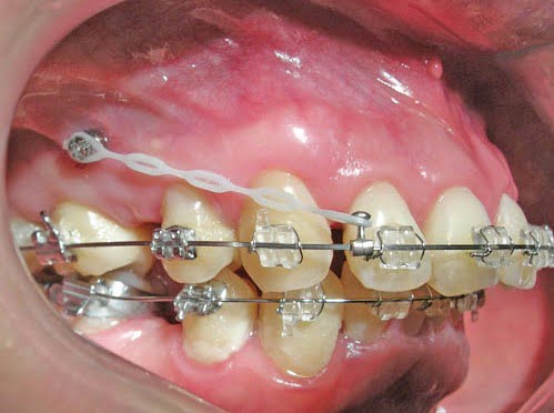 Quy trình niềng răng hô tại Nha khoa