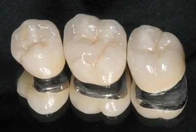 Mức giá bọc răng sứ Cercon 2
