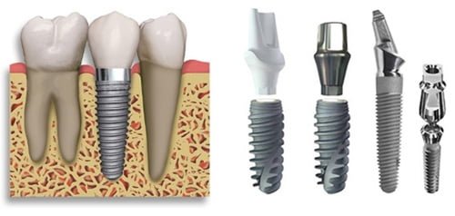 Thắc mắc về độ bền của răng Implant nha khoa 1
