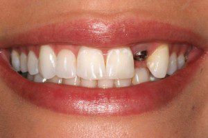 Mất răng cửa nên làm cầu răng hay trồng răng implant