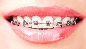 Phân nhóm khí cụ trong chỉnh nha 