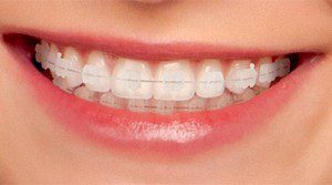 Trường hợp niềng răng sau khi bọc răng sứ