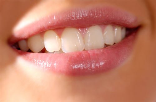 Thời gian niềng răng chỉnh hô là bao lâu ?