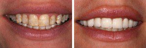 Mất tự tin khi răng nhiễm tetracycline và cách giải quyết