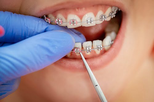 Khắc phục răng móm có những cách nào ?