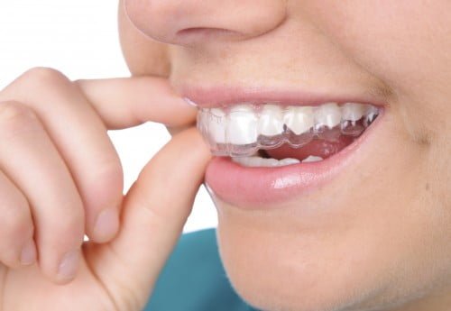 Những điều cần biết về niềng răng Invisalign