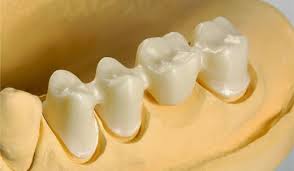 Những thắc mắc về trồng răng sứ