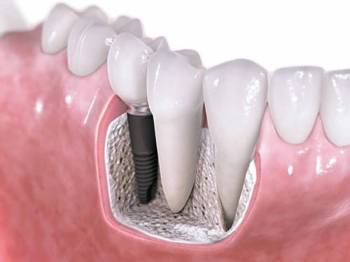 Phục hình răng bị mất với implant