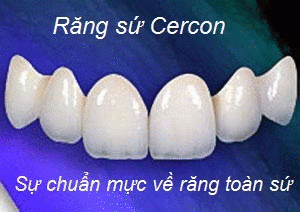 Mức giá bọc răng sứ Cercon 3