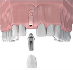 Trồng implant răng cửa có đau không?