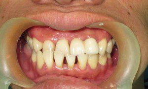 Niềng răng thẩm mỹ để cải thiện răng thưa 