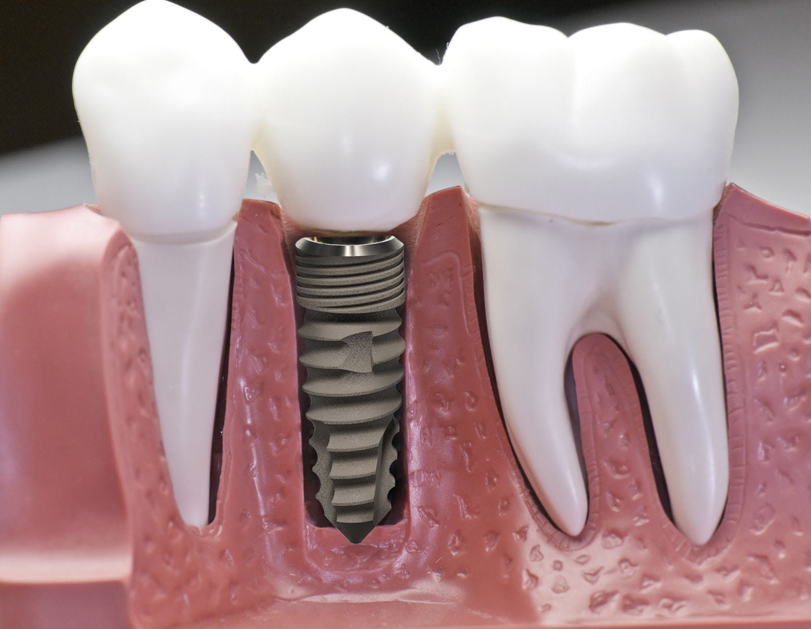 Cấy ghép Implant răng hàm như thế nào