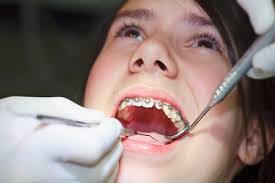 Giúp bạn hiểu rõ hơn về phương pháp niềng răng