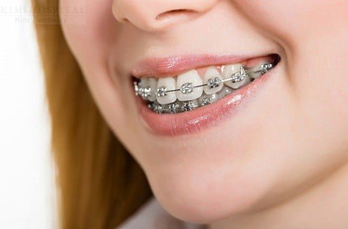 Khắc phục răng hô hàm trên như thế nào ?