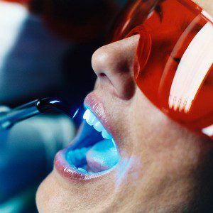 Những dịch vụ tẩy trắng răng phổ biến