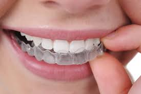 Những dịch vụ tẩy trắng răng phổ biến