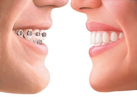 Niềng răng có tác dụng quan trọng gì? 3