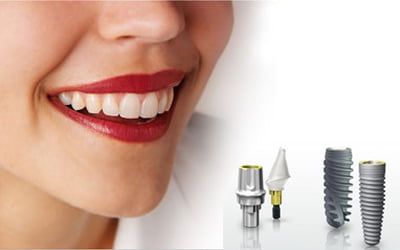 Những lợi ích của trồng răng Implant 3