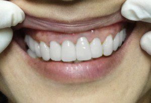 Răng cửa bọc sứ có niềng răng được không? 