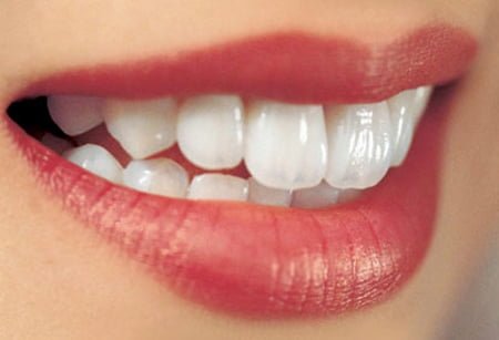 Tẩy trắng răng bằng Laser Whitening có hại không?