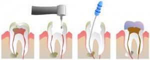 Cách bảo vệ răng sau khi lấy tủy 