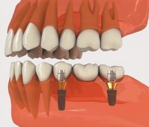 Cấy ghép implant có ảnh hưởng gì đến xương hàm không? 
